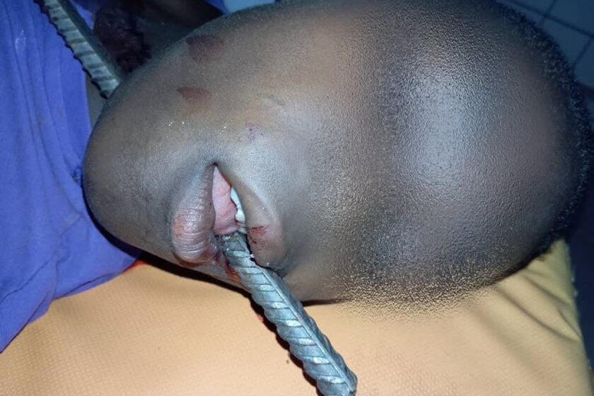 Burkina : Une prouesse chirurgicale sauve un enfant blessé par une barre de fer